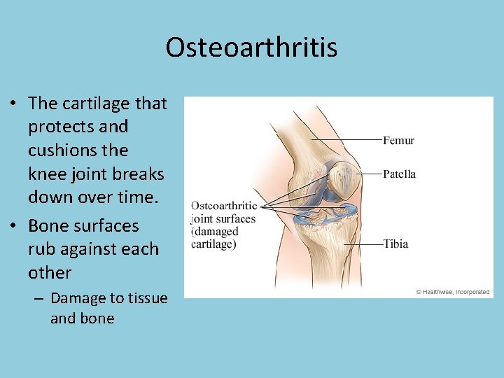 Osteoarthritis • The cartilage that protects and cushions the knee joint breaks down over