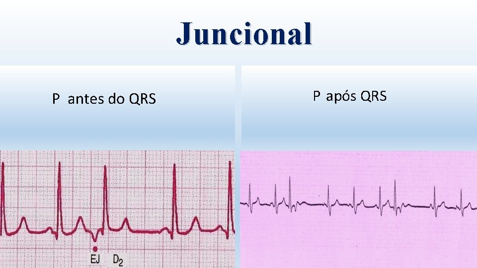 Juncional P antes do QRS P após QRS 