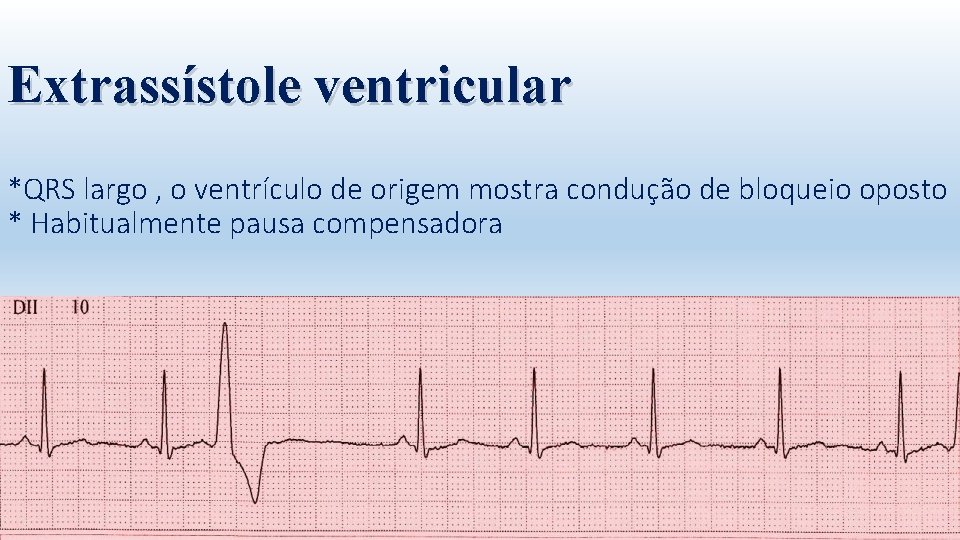 Extrassístole ventricular *QRS largo , o ventrículo de origem mostra condução de bloqueio oposto