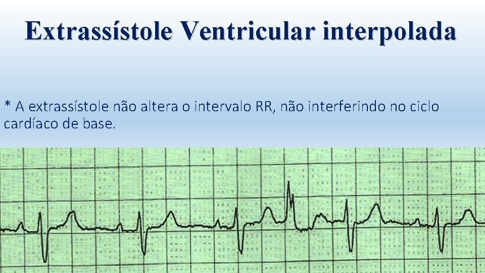 Extrassístole Ventricular interpolada * A extrassístole não altera o intervalo RR, não interferindo no