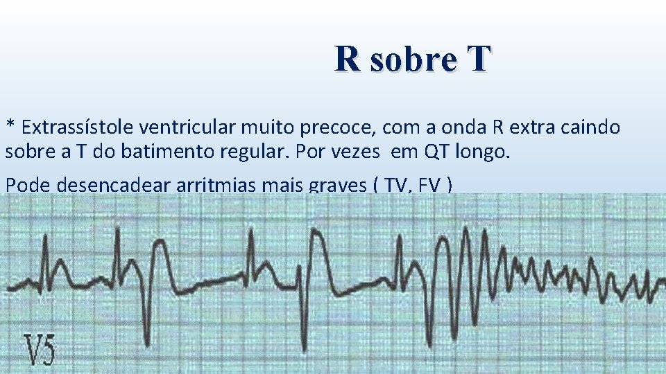 R sobre T * Extrassístole ventricular muito precoce, com a onda R extra caindo