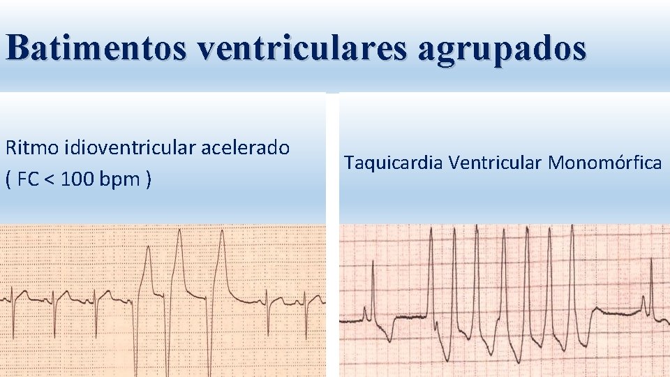 Batimentos ventriculares agrupados Ritmo idioventricular acelerado ( FC < 100 bpm ) Taquicardia Ventricular