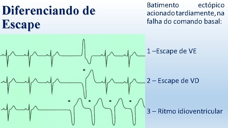 Diferenciando de Escape Batimento ectópico acionado tardiamente, na falha do comando basal: 1 –Escape