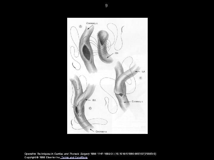 9 Operative Techniques in Cardiac and Thoracic Surgery 1996 1147 -159 DOI: (10. 1016/S