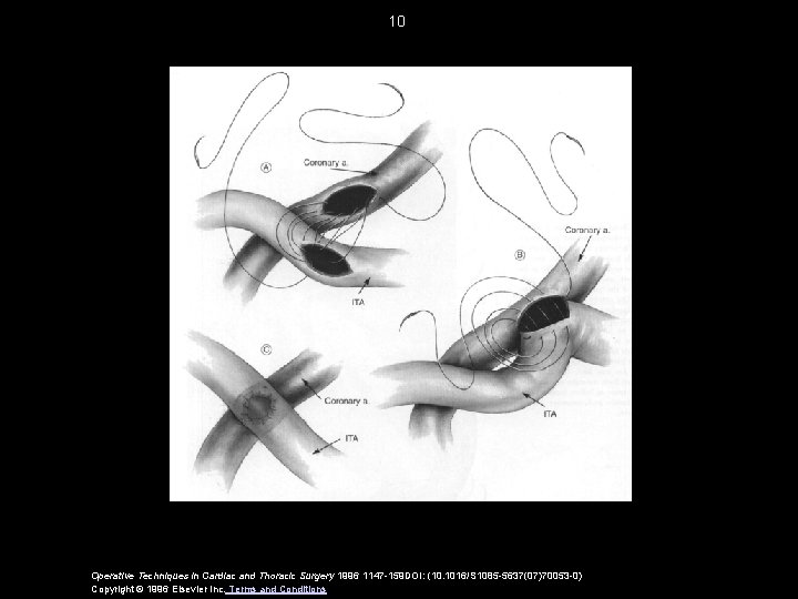 10 Operative Techniques in Cardiac and Thoracic Surgery 1996 1147 -159 DOI: (10. 1016/S