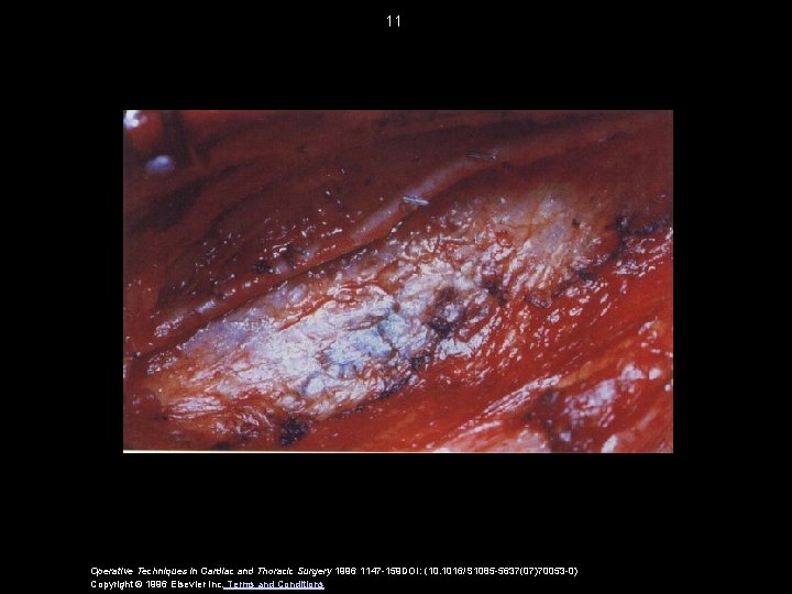 11 Operative Techniques in Cardiac and Thoracic Surgery 1996 1147 -159 DOI: (10. 1016/S