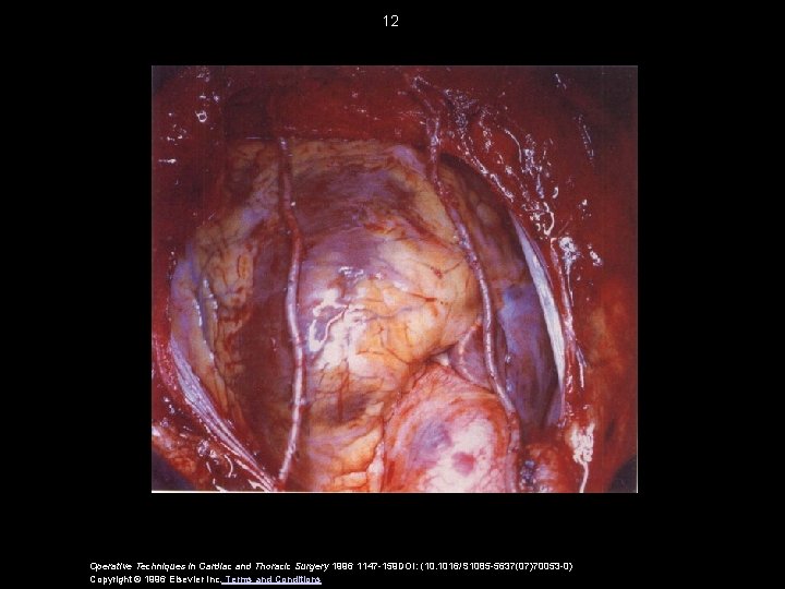 12 Operative Techniques in Cardiac and Thoracic Surgery 1996 1147 -159 DOI: (10. 1016/S