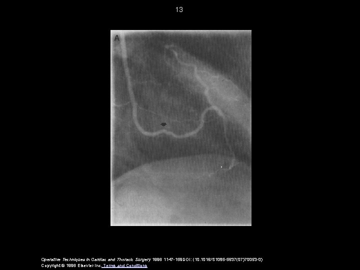 13 Operative Techniques in Cardiac and Thoracic Surgery 1996 1147 -159 DOI: (10. 1016/S