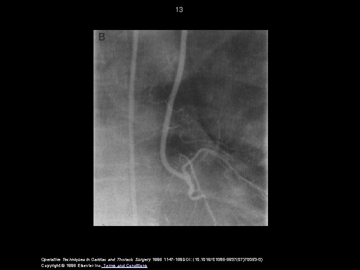 13 Operative Techniques in Cardiac and Thoracic Surgery 1996 1147 -159 DOI: (10. 1016/S