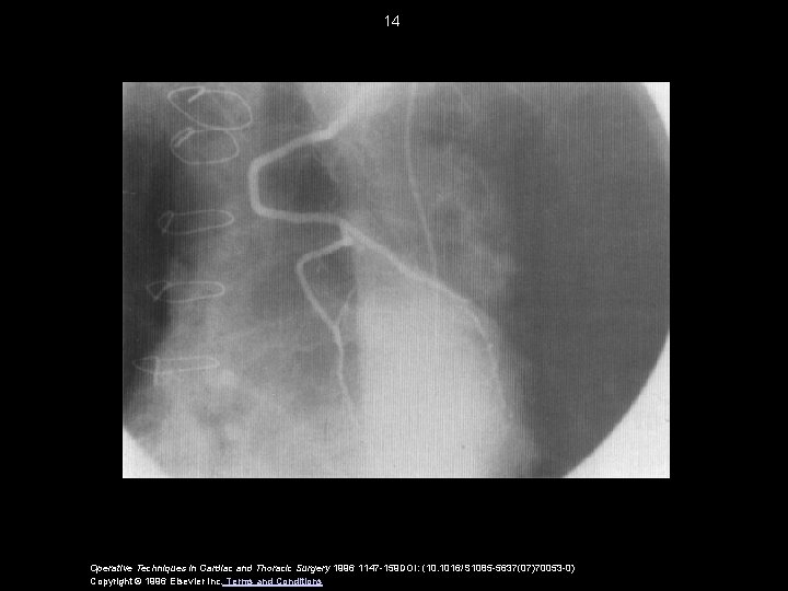 14 Operative Techniques in Cardiac and Thoracic Surgery 1996 1147 -159 DOI: (10. 1016/S