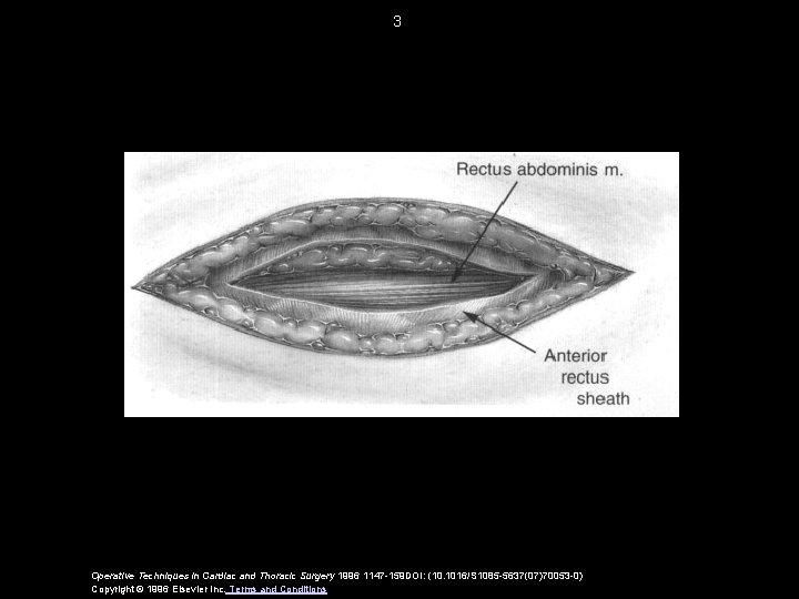 3 Operative Techniques in Cardiac and Thoracic Surgery 1996 1147 -159 DOI: (10. 1016/S