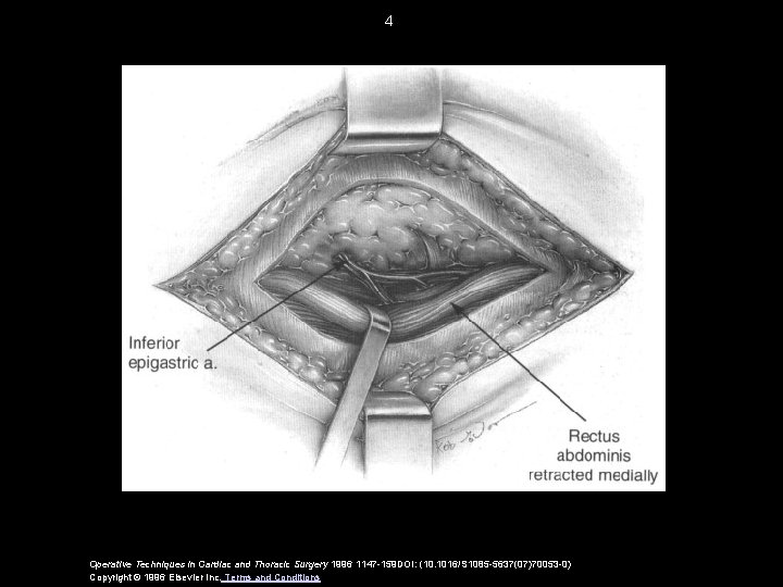 4 Operative Techniques in Cardiac and Thoracic Surgery 1996 1147 -159 DOI: (10. 1016/S