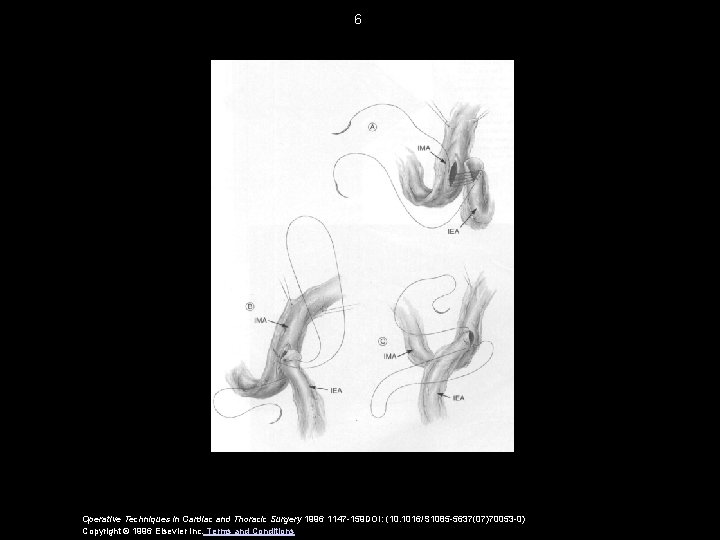 6 Operative Techniques in Cardiac and Thoracic Surgery 1996 1147 -159 DOI: (10. 1016/S