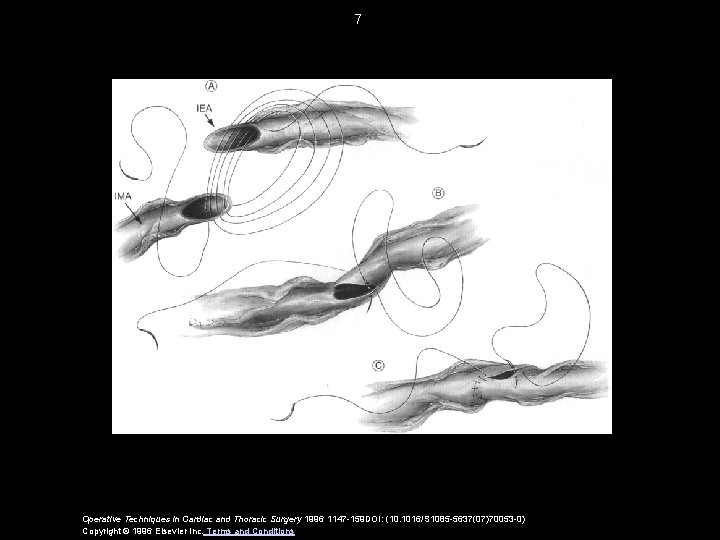 7 Operative Techniques in Cardiac and Thoracic Surgery 1996 1147 -159 DOI: (10. 1016/S