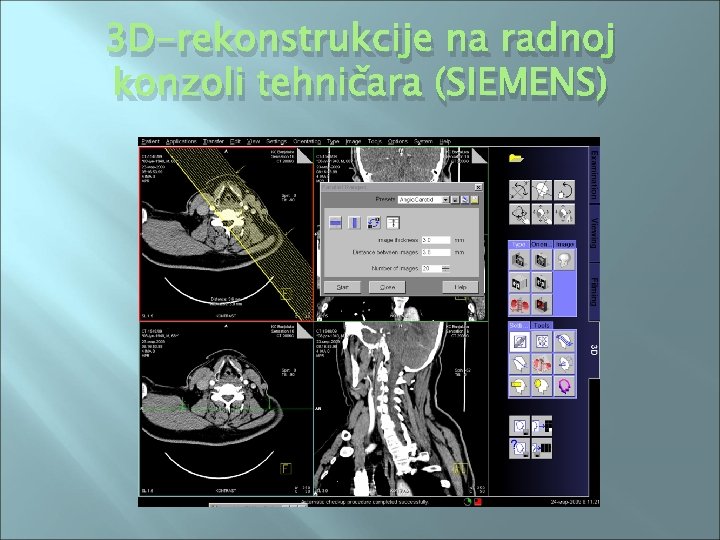 3 D-rekonstrukcije na radnoj konzoli tehničara (SIEMENS) 