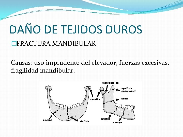 DAÑO DE TEJIDOS DUROS �FRACTURA MANDIBULAR Causas: uso imprudente del elevador, fuerzas excesivas, fragilidad