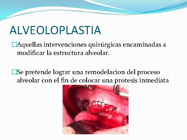 ALVEOLOPLASTIA �Aquellas intervenciones quirúrgicas encaminadas a modificar la estructura alveolar. �Se pretende lograr una