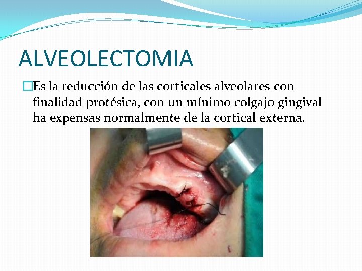 ALVEOLECTOMIA �Es la reducción de las corticales alveolares con finalidad protésica, con un mínimo