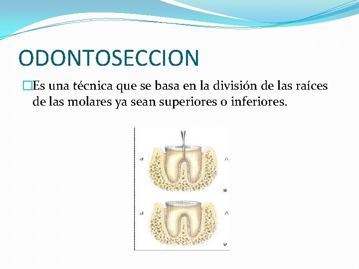 ODONTOSECCION �Es una técnica que se basa en la división de las raíces de