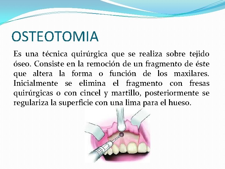 OSTEOTOMIA Es una técnica quirúrgica que se realiza sobre tejido óseo. Consiste en la