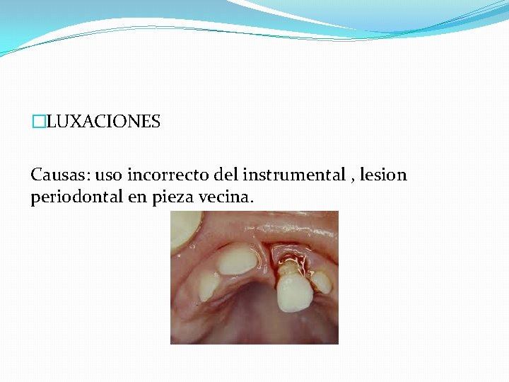 �LUXACIONES Causas: uso incorrecto del instrumental , lesion periodontal en pieza vecina. 
