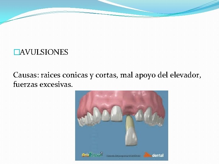 �AVULSIONES Causas: raices conicas y cortas, mal apoyo del elevador, fuerzas excesivas. 