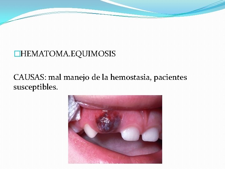 �HEMATOMA. EQUIMOSIS CAUSAS: mal manejo de la hemostasia, pacientes susceptibles. 