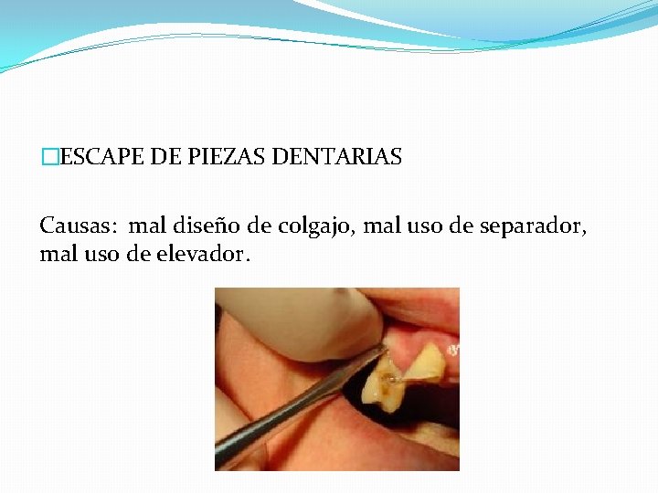 �ESCAPE DE PIEZAS DENTARIAS Causas: mal diseño de colgajo, mal uso de separador, mal