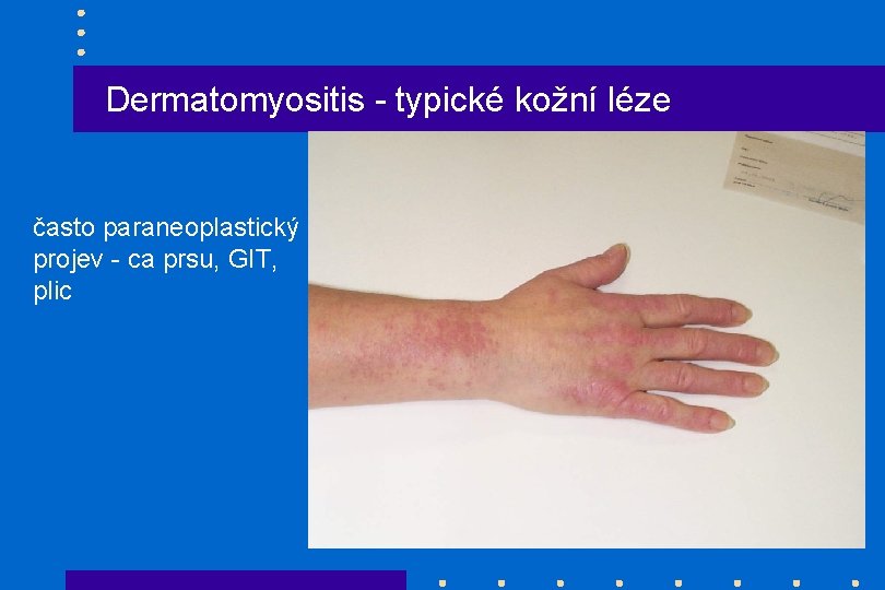 Dermatomyositis - typické kožní léze často paraneoplastický projev - ca prsu, GIT, plic 