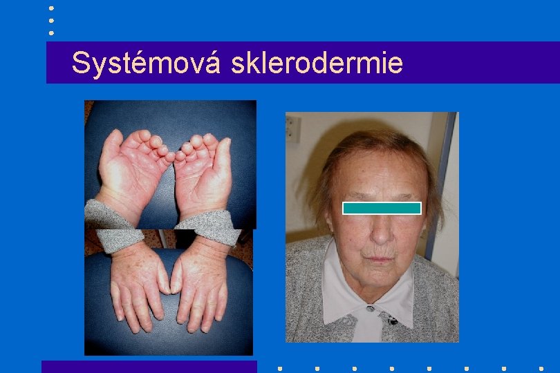 Systémová sklerodermie 