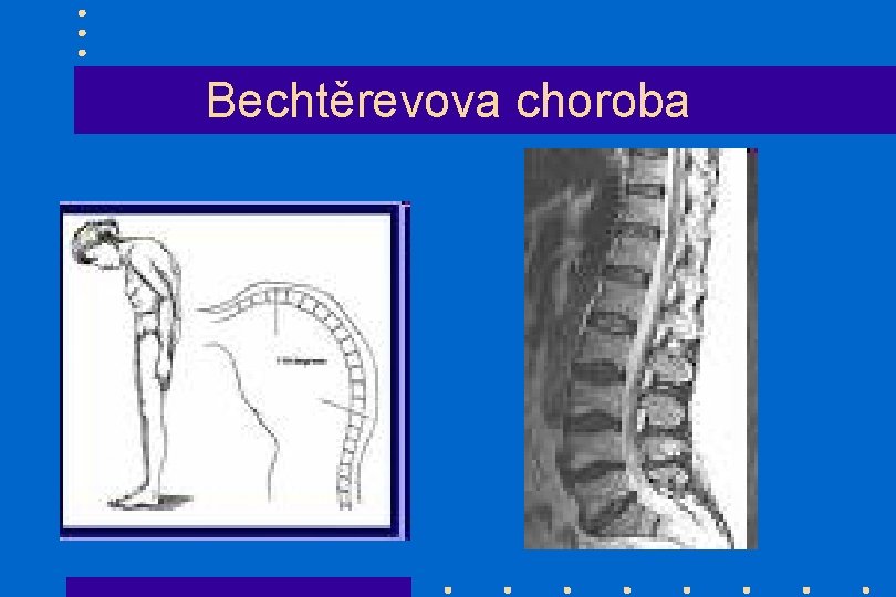 Bechtěrevova choroba 