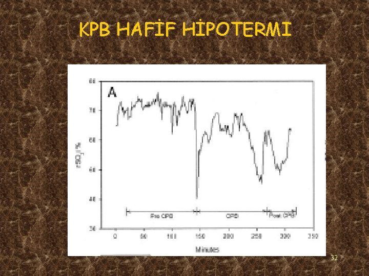 KPB HAFİF HİPOTERMI 32 