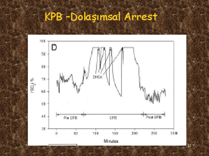 KPB –Dolaşımsal Arrest 35 