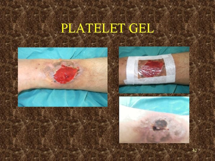 PLATELET GEL 42 