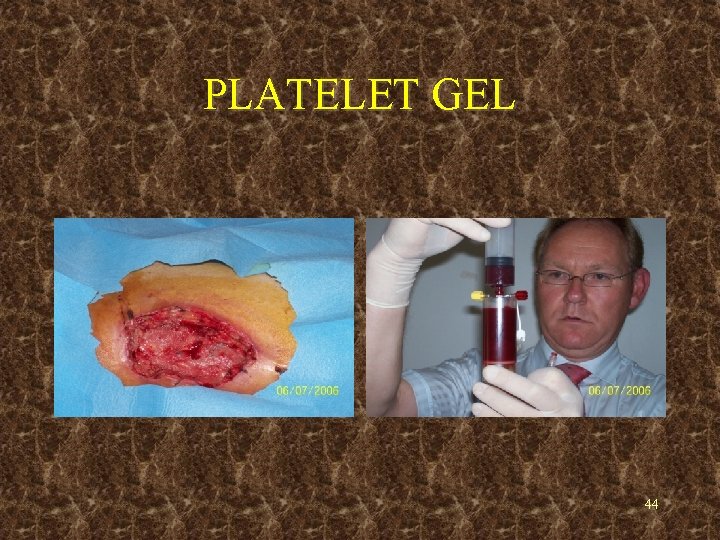 PLATELET GEL 44 