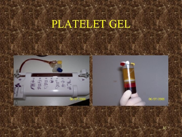 PLATELET GEL 45 