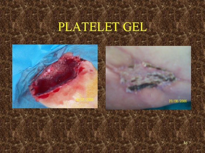 PLATELET GEL 46 