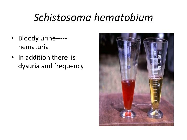 schistosomiasis hematuria