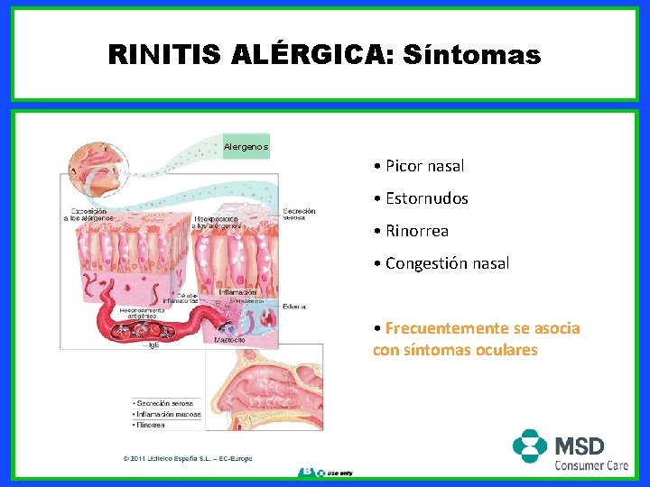 RINITIS ALÉRGICA: Síntomas Alergenos • Picor nasal • Estornudos • Rinorrea • Congestión nasal