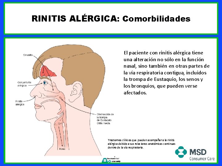RINITIS ALÉRGICA: Comorbilidades El paciente con rinitis alérgica tiene una alteración no sólo en