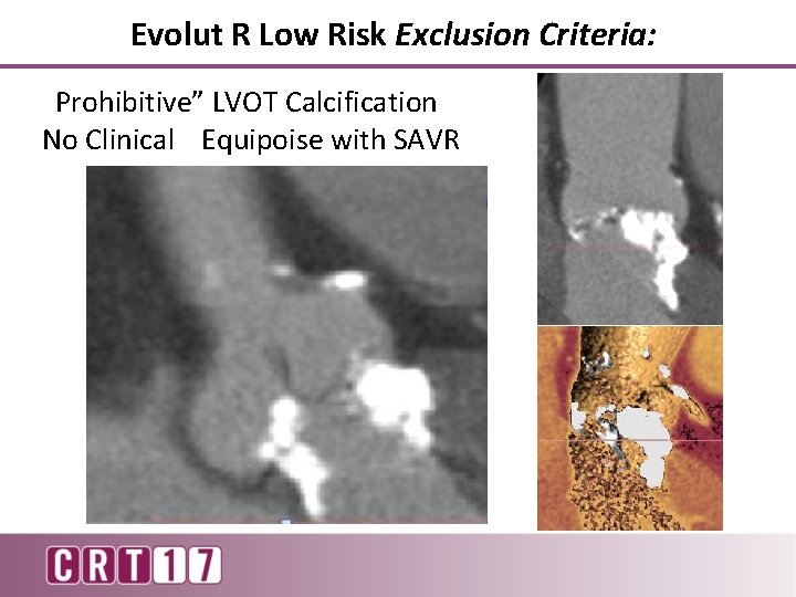 Evolut R Low Risk Exclusion Criteria: “Prohibitive” LVOT Calcification No Clinical Equipoise with SAVR