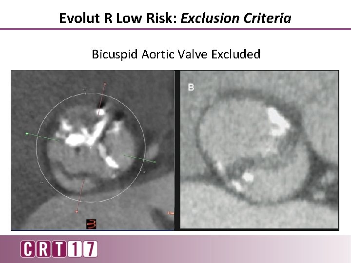 Evolut R Low Risk: Exclusion Criteria Bicuspid Aortic Valve Excluded 