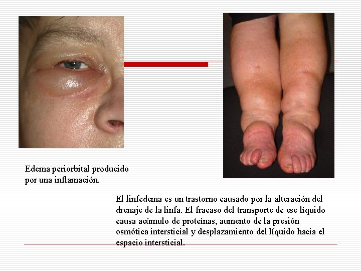 Edema periorbital producido por una inflamación. El linfedema es un trastorno causado por la