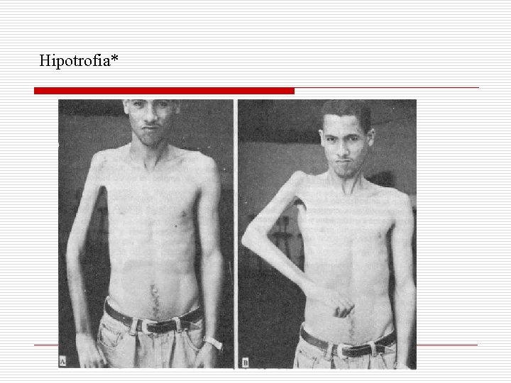 Hipotrofia* 
