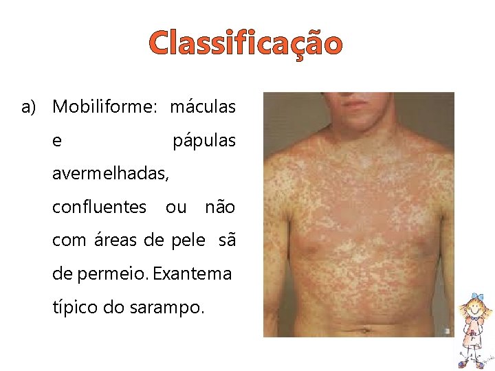 Classificação a) Mobiliforme: máculas e pápulas avermelhadas, confluentes ou não com áreas de pele