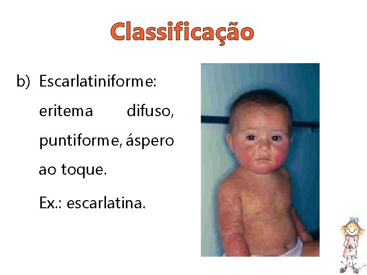 Classificação b) Escarlatiniforme: eritema difuso, puntiforme, áspero ao toque. Ex. : escarlatina. 