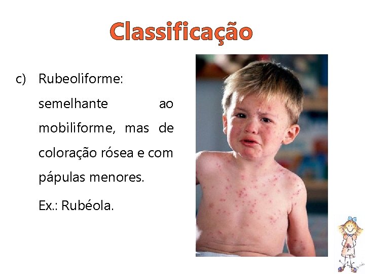 Classificação c) Rubeoliforme: semelhante ao mobiliforme, mas de coloração rósea e com pápulas menores.