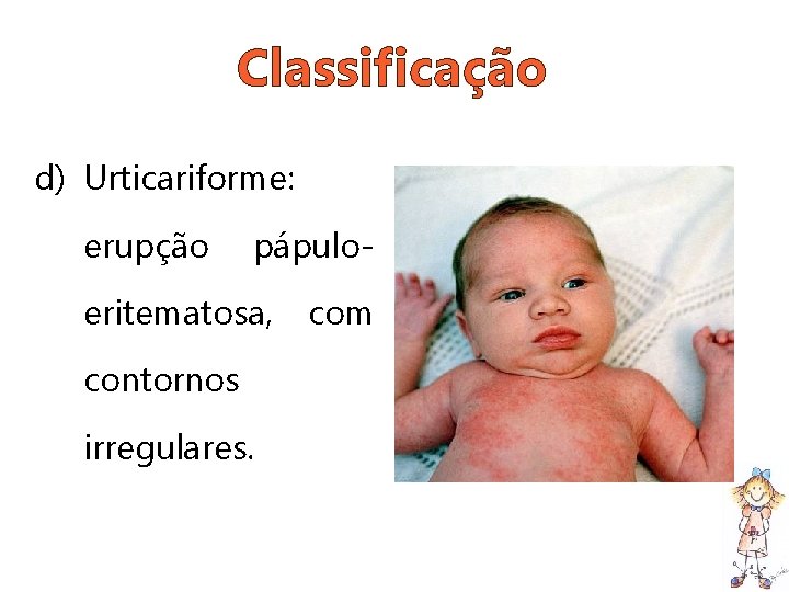 Classificação d) Urticariforme: erupção pápulo- eritematosa, com contornos irregulares. 