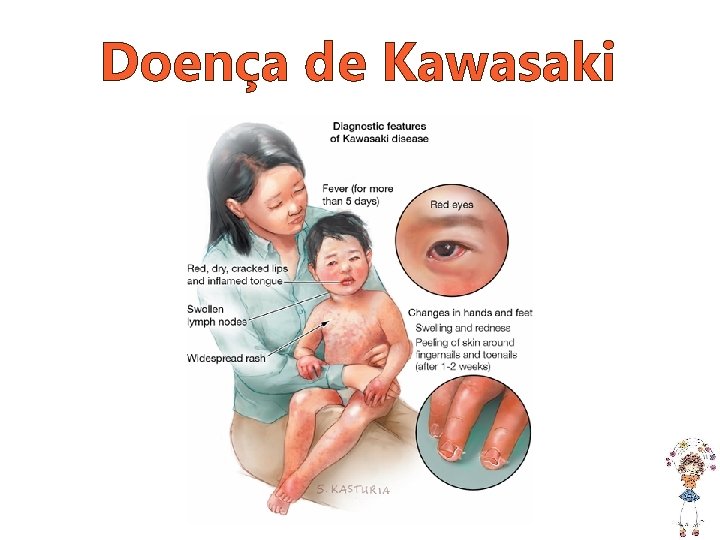 Doença de Kawasaki 