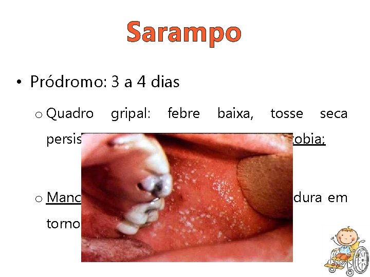 Sarampo • Pródromo: 3 a 4 dias o Quadro gripal: febre baixa, tosse seca